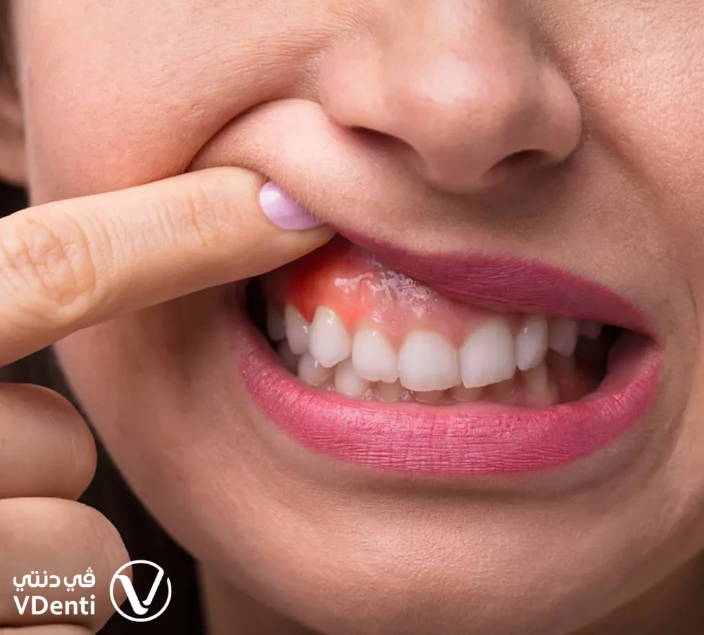 شكل خراج الأسنان بالصور