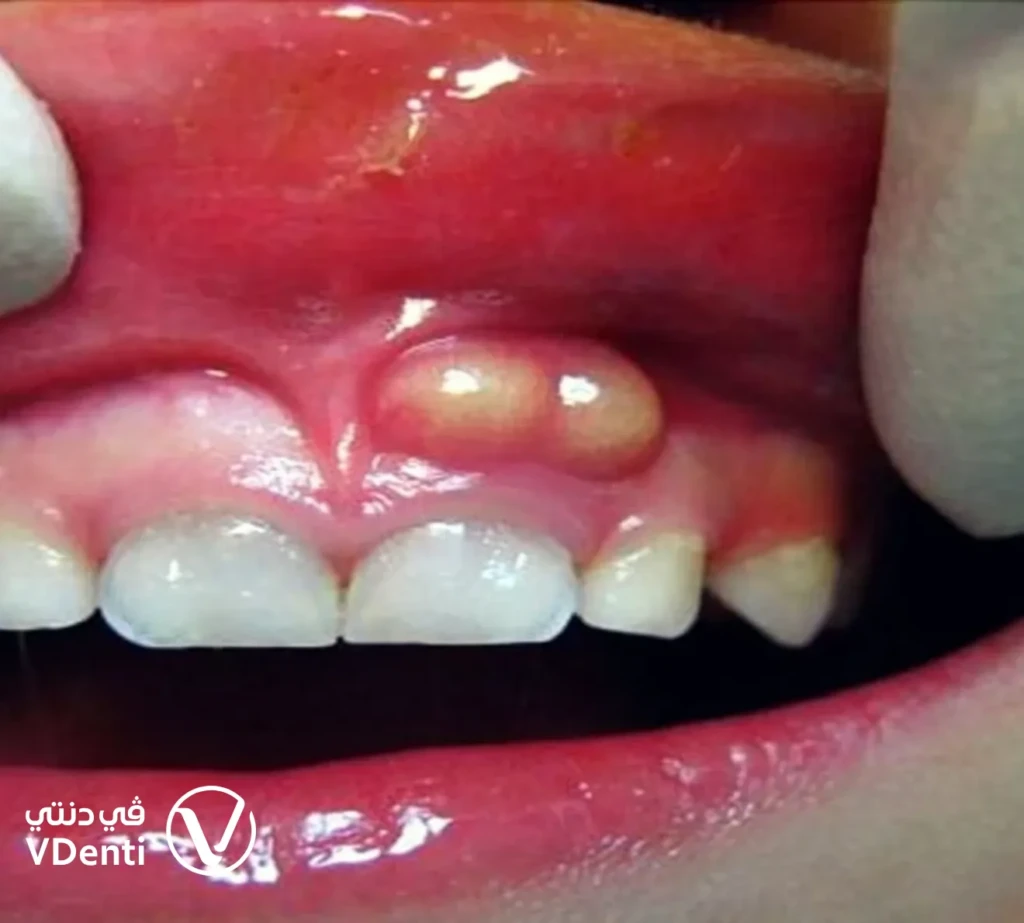شكل خراج اللثة بالصور