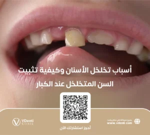 أسباب تخلخل الأسنان