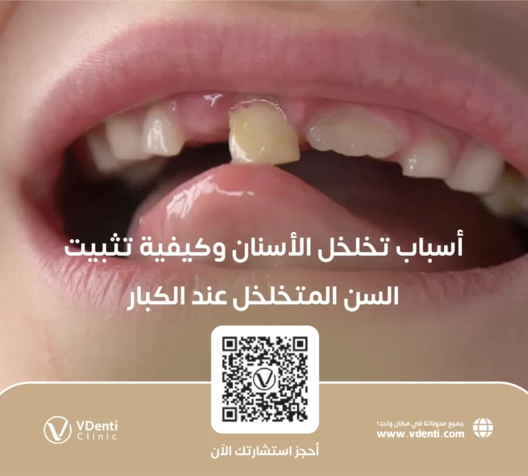 أسباب تخلخل الأسنان