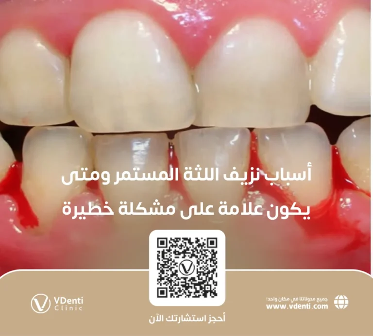أسباب نزيف اللثة المستمر