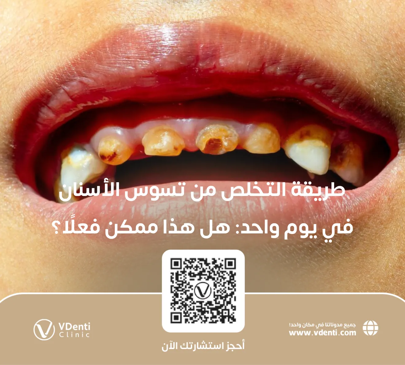 طريقة التخلص من تسوس الأسنان في يوم واحد