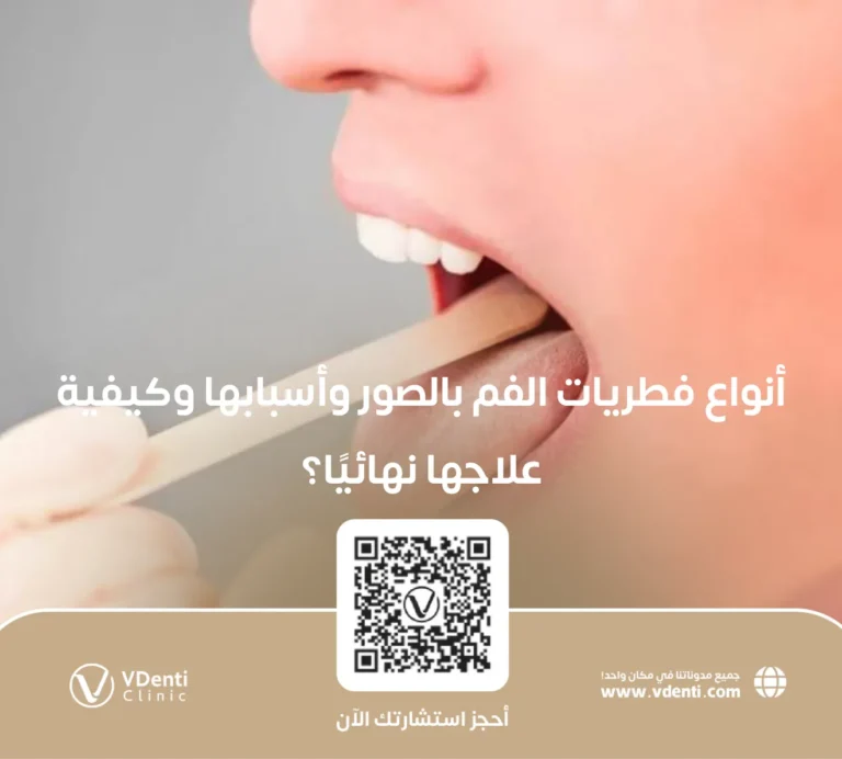 أنواع فطريات الفم بالصور