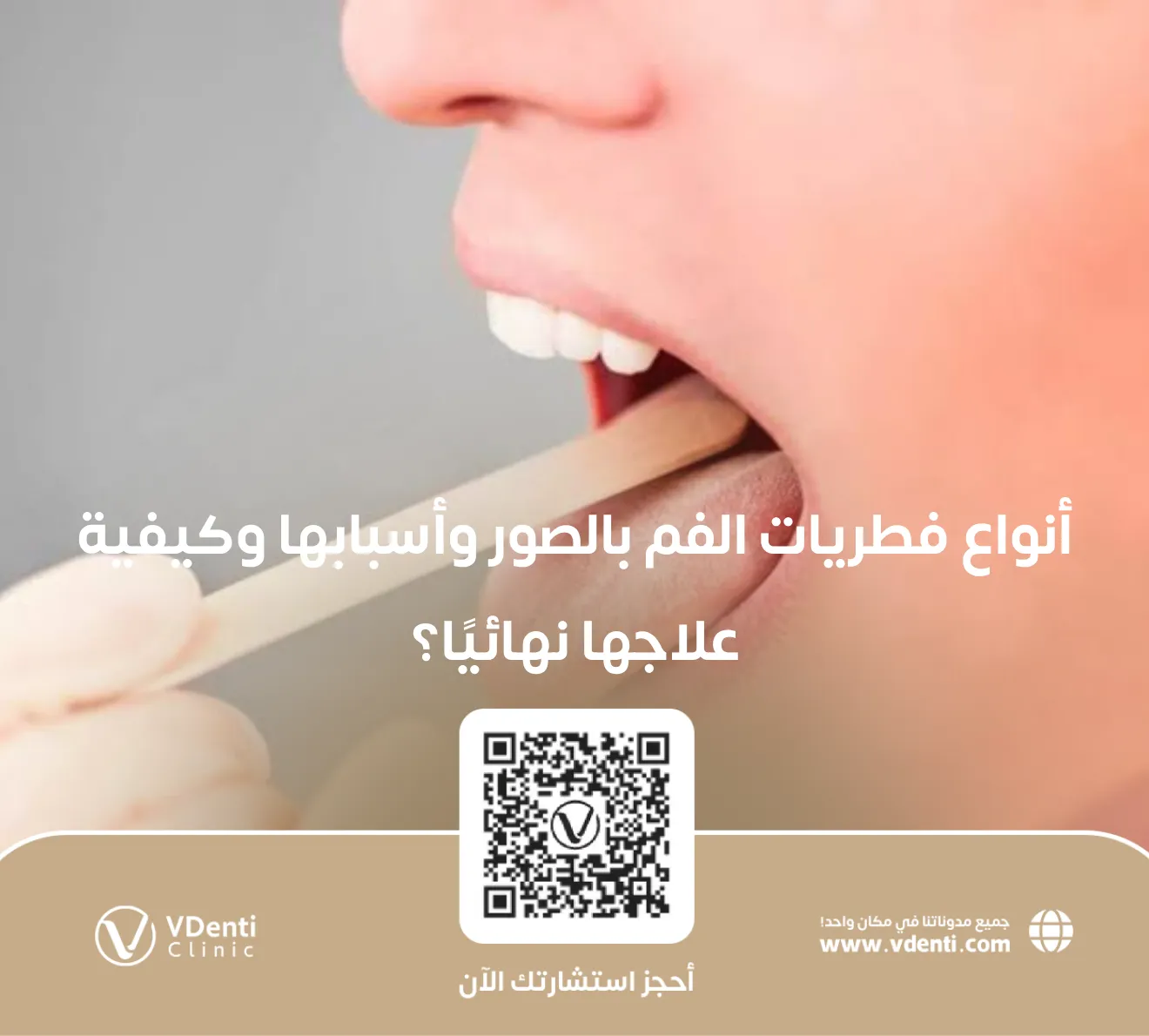 أنواع فطريات الفم بالصور