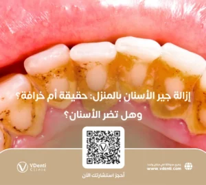 إزالة جير الأسنان بالمنزل