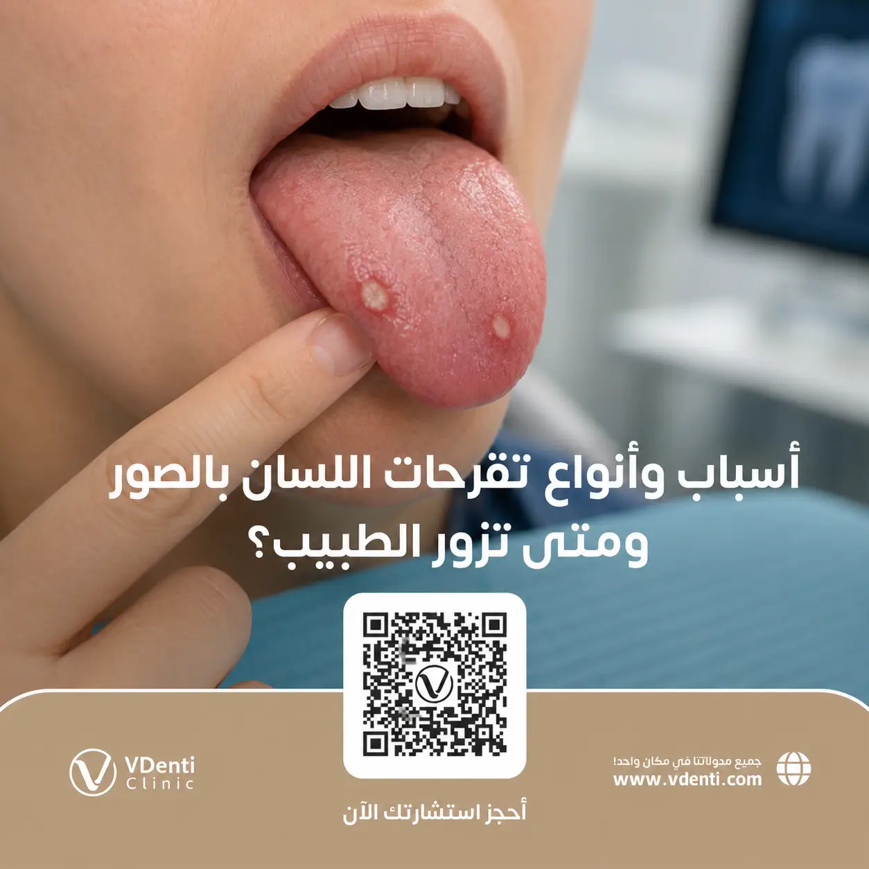 أسباب وأنواع تقرحات اللسان بالصور