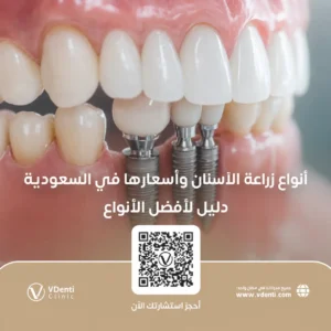 أنواع زراعة الأسنان واسعارها في السعودية